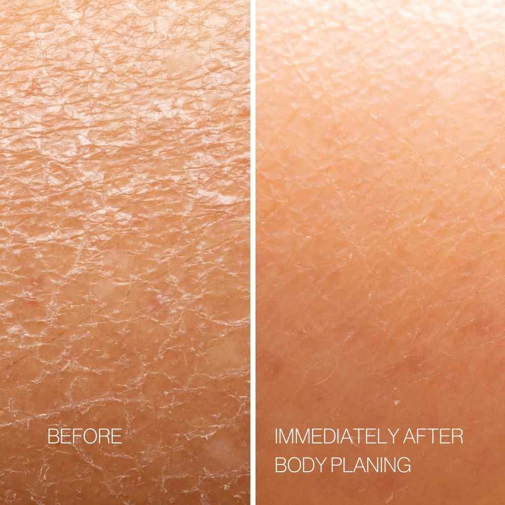 Body Plane Exfoliation Tool Set